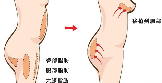 自体脂肪填充丰胸有危害吗?尽美整形网