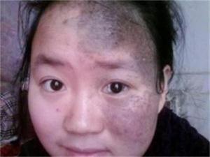 长了太田痣怎么办?如何治疗好?