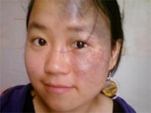 长了太田痣怎么办?如何治疗好?