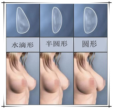 假体隆胸怎么选择?术后手感怎样?