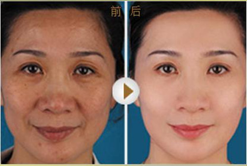热玛吉和*的区别?那个*果好?