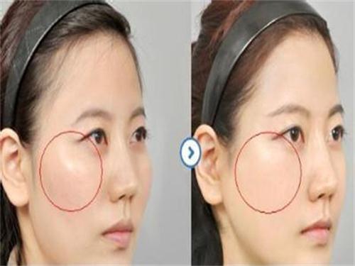磨颧骨手术是什么?该注意的地方有哪些?
