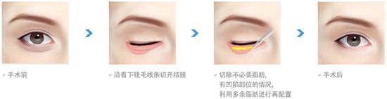 为什么要去眼袋?有哪些有*的方法?