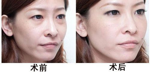 为什么要去眼袋?有哪些有*的方法?