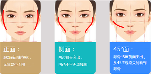 磨颧骨适合哪些人做?哪些脸型可以做?