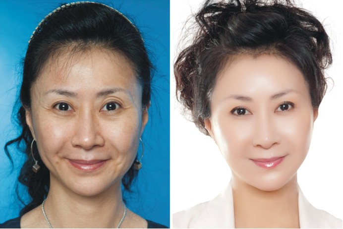 什么是手术拉皮提升面部?适合那些人做?