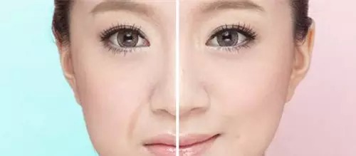 自体脂肪填充法令纹,*果能保持多久呢?