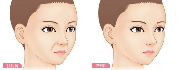 自体脂肪填充法令纹,*果能保持多久呢?