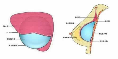 复合隆胸适合哪些人?|尽美网
