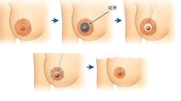乳头乳晕缩小怎么做?*果好不好?|尽美网