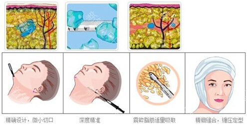 吸脂瘦脸会不会反弹?|尽美网