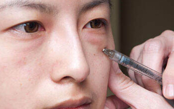 玻尿酸填泪沟多少钱?*果能维持好久?
