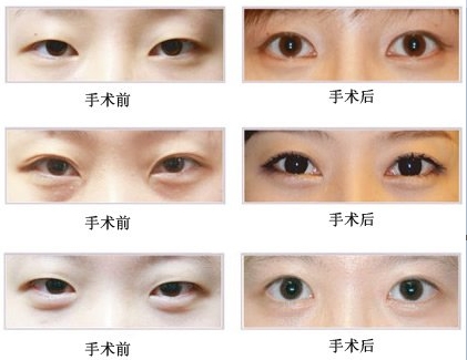 开眼角适合哪些人做?|尽美网