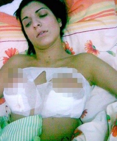丰胸失败双乳被切除丰胸手术风险有哪些?|尽美