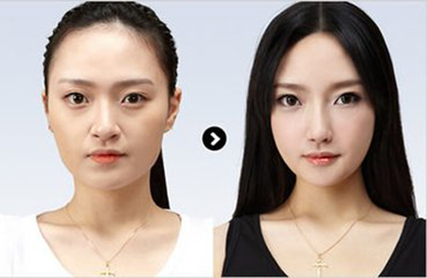 隆鼻4大后遗症,3个方法避免后遗症发生