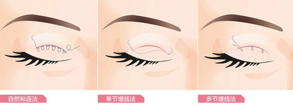 “埋线双眼皮”手术时候有多疼?