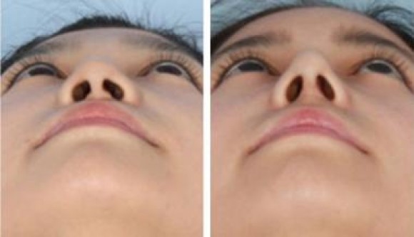 隆鼻的方法有哪些？亚洲人适合哪种隆鼻方法？