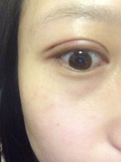 埋线双眼皮3天就能恢复?
