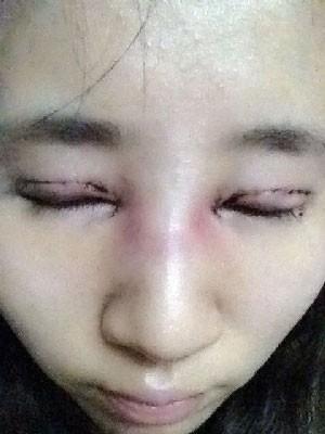 双眼皮+开眼角+隆鼻 来一个大变身