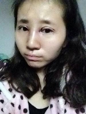 双眼皮+开眼角+隆鼻 来一个大变身