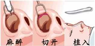 隆鼻*为较好的2种方法,其中一种*但却慢慢