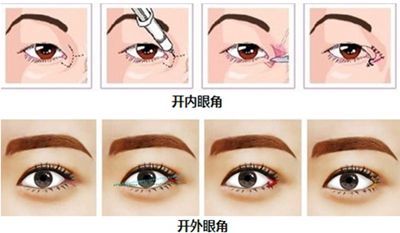 长沙开眼角怎么样?多少钱?