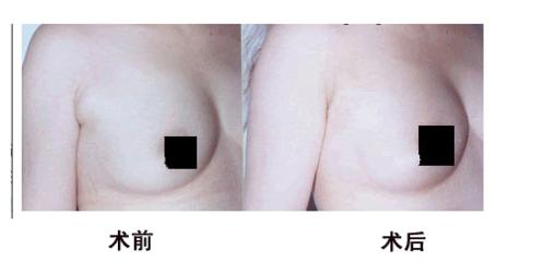 除副乳手术的*佳时机