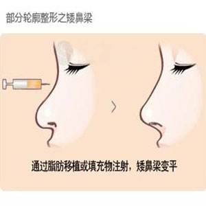 自体脂肪填充隆鼻的价格是多少?