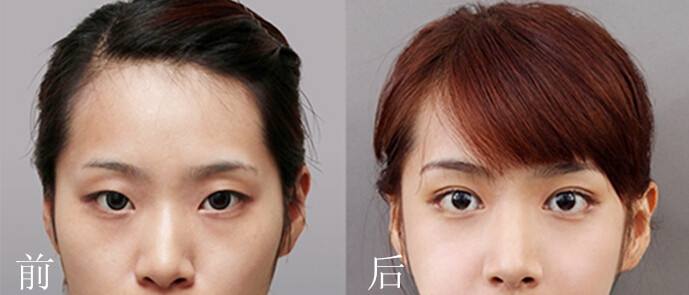 武汉做双眼皮手术多少钱?