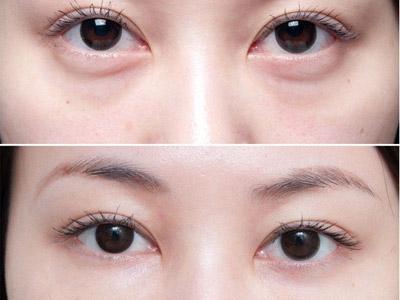 广州眼部吸脂术的价格是多少?