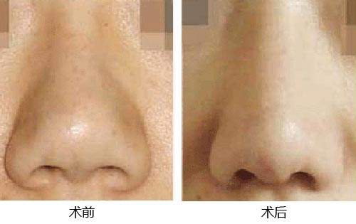 北京东方瑞丽王军鼻小柱延长术多少钱?