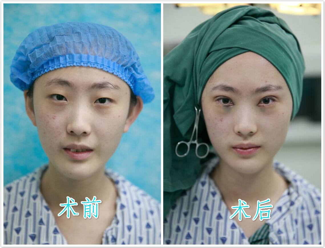 济南韩美朱文政上睑下垂矫正术的价格是多少?