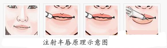 北京玉之光王明利丰唇术价格是多少?
