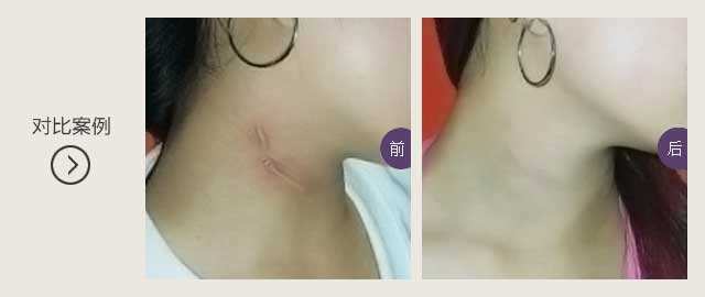 疤痕修复术需要满足什么条件才能更容易成功?