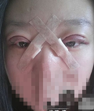 总于有了双眼皮,以后不用贴双眼皮贴了