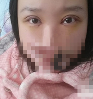 总于有了双眼皮,以后不用贴双眼皮贴了