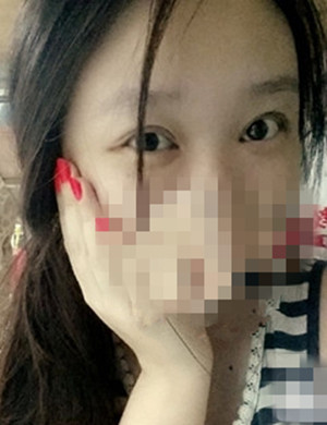 总于有了双眼皮,以后不用贴双眼皮贴了