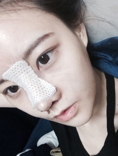 隆鼻+自体脂肪填充，美了
