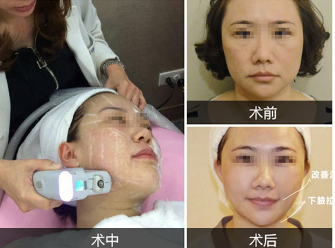 除皱的方法有哪些?