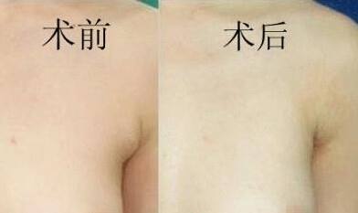 副乳切除术后切口*吗?