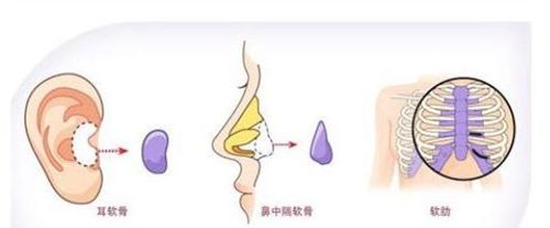 什么是自体软骨隆鼻,自体软骨隆鼻多少钱?