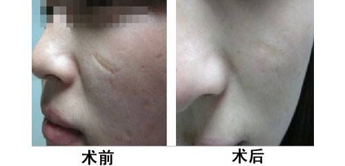 激光祛疤手术前有哪些注意事项?