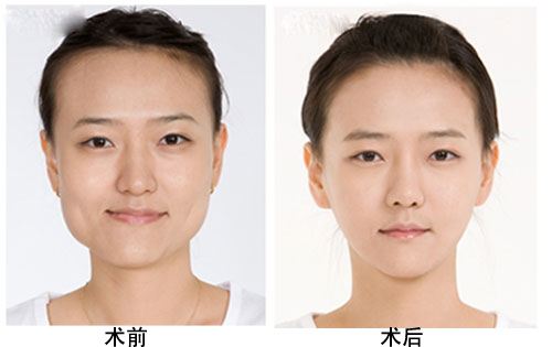 上海下颌角磨骨术的价格是多少?