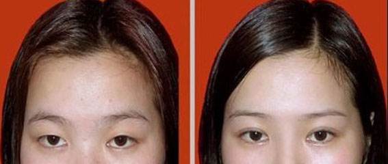 埋线双眼皮手术*果怎么样呢?