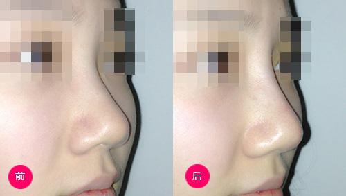 玻尿酸隆鼻后有哪些注意事项呢?