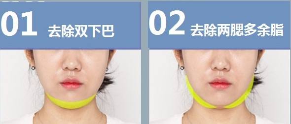 面部吸脂手术后会反弹吗?