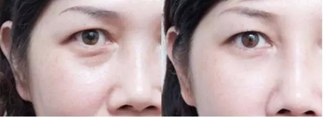 吸脂祛眼袋手术后会复发吗?