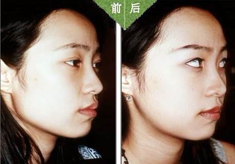 北京磨下颌角多少钱?