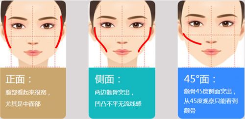 深圳磨颧骨的费用是多少?