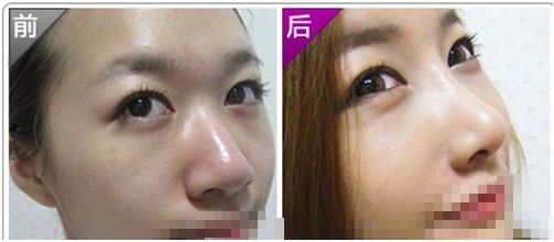 鼻翼缩小术后应该如何护理?